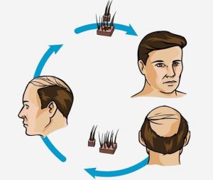 Transplante de pelo