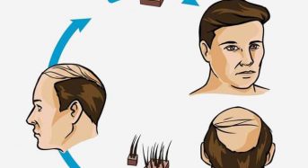 Los implantes de pelo en Tabarnia serán más económicos que en Turquía.