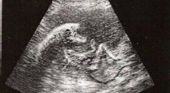 EXCLUSIVA: Filtrada la primera ecografía del bebe de Alberto Garzón y Anna Ruiz.