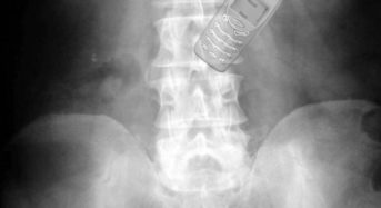Descubre que el cirujano que le operó, hace 5 meses, se dejó dentro un Nokia 3315